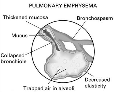 COPD: Emphysema Alveoli walls break down surface area for respiratory exchange is greatly reduced Lungs lose elasticity Results in air being trapped in lungs, reducing effectiveness of normal