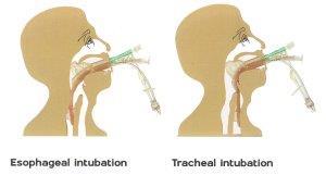 Blindly inserted 2 tubes in 1 Esophageal