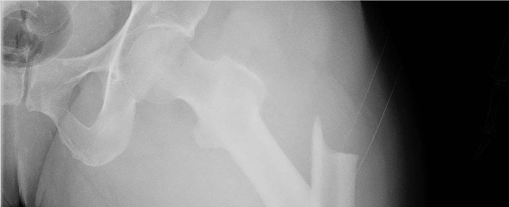 Atypical Femur Fractures Case reports Case series RCT