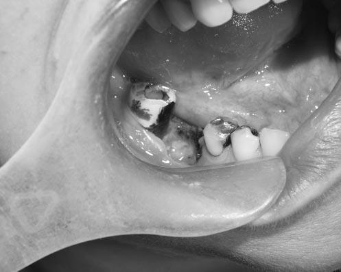 Guidelines for the diagnosis of bisphosphonate related osteonecrosis of the jaw (BRONJ) Figure 1 - A non-healing extraction site in a patient with a history of intravenous bisphosphonate exposure.