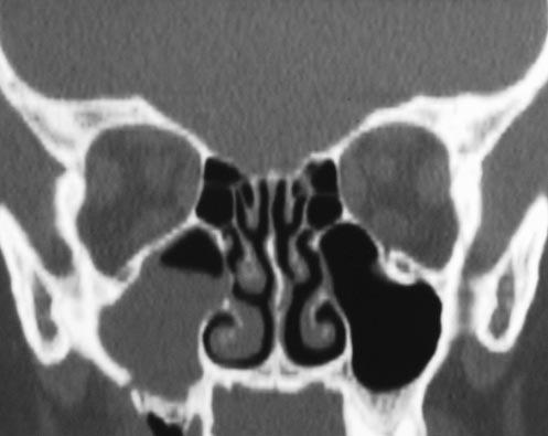 Little or no ossification at a previous extraction site may represent an early radiographic sign.