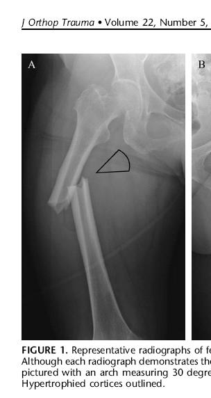 Atypical subtrochanteric fractures: Case Reports and Case Studies Typical Morphologic Characteristics of Atypical Fractures from Case Reports First identified in case reports and case series NY and