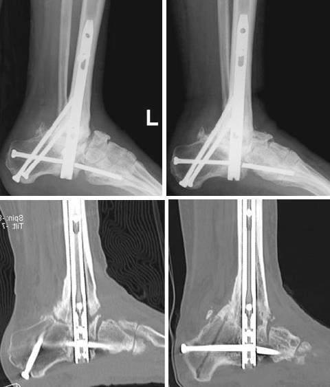 after multiple arthrodesis operations for
