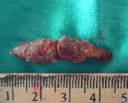 5: Right ureteric stone (3.5 cm long) Fig.