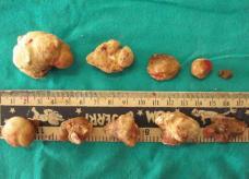 Fig. 9: Stones extracted from right kidney Fig.