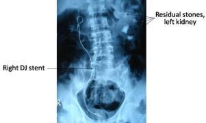 Fig. 11: Plain skiagram KUB showing residual stones in left kidney.