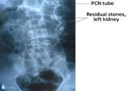12: Plain skiagram KUB after PCN (per cutaneous nephrostomy)