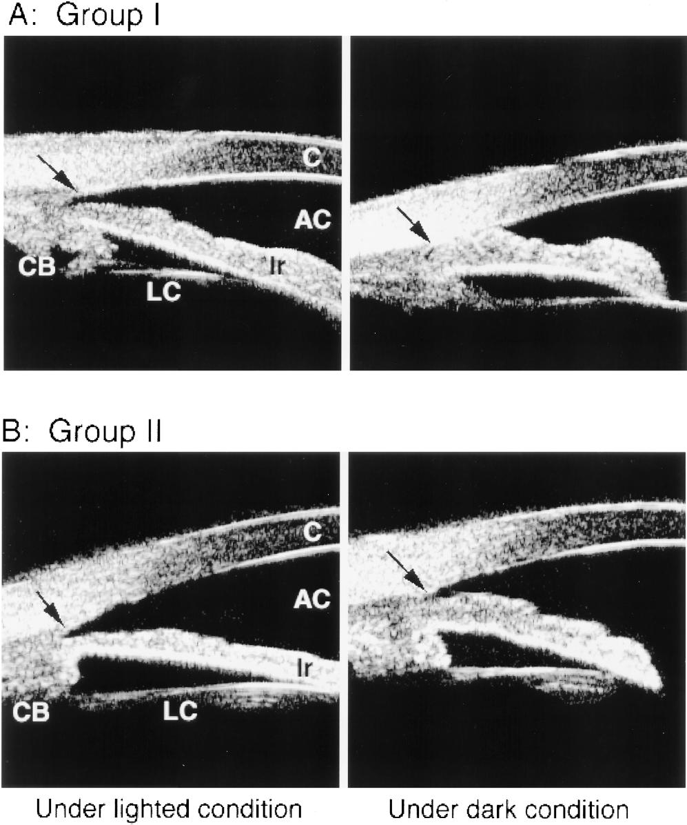 530 Jpn J Ophthalmol Vol 43: 526 534, 1999 Figure 3. Ultrasound biomicroscopy images of both groups.