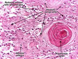 Neoplasms of Skin Keratinocytic Tumors Basal Cell Carcinoma Squamous Cell Carcinoma Actinic Keratosis Verruca Acanthoma Melanocytic Tumors Malignant Melanoma Lentigo