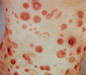 Neoplasms of Skin Hematolymphoid Tumors Mastocytosis Parapsoriasis Sezary Syndrome Mycosis Fungoides Hodgkin Lymphoma Cutaneous
