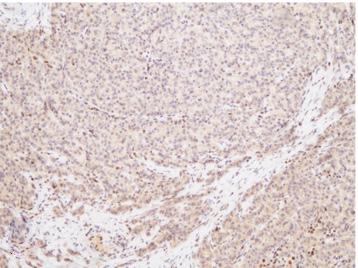 Neoplastic cells display a trabecular pattern. Tumor cell nuclei show loss of MLH1 and PMS2 expression (A,B) and maintain MSH2 and MSH6 expression (C,D). IHC, immunohistochemistry.