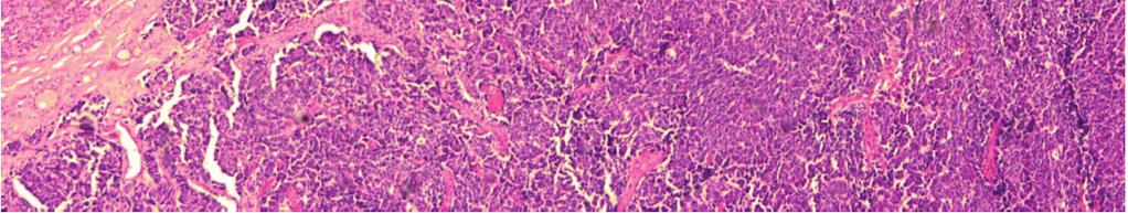 (c) The metastatic carcinoma is negative for thyroglobulin, while the adenoma is strongly positive (magnification 100).