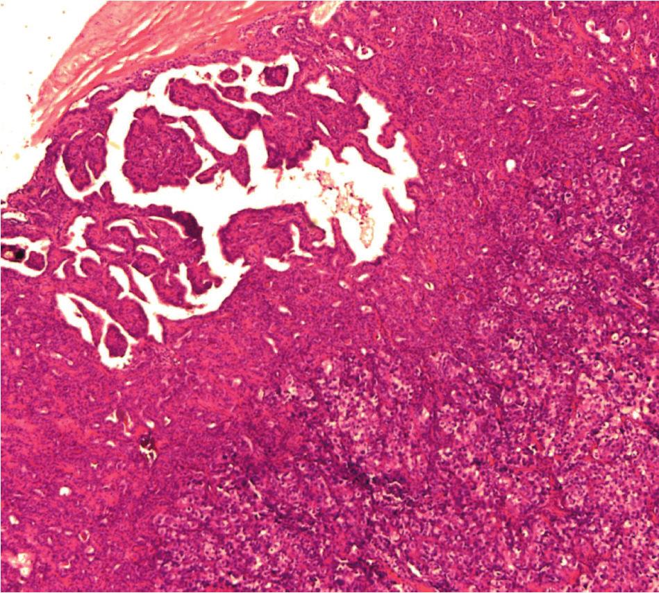 Case Reports in Pathology 3 (a) (b) (c) (d) Figure 2: (a) Within the papillary carcinoma is an abrupt transition to a morphologically distinct neoplasm (magnification 40).