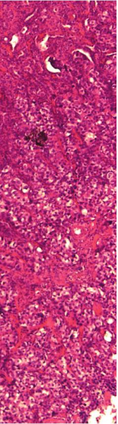 (c) Napsin-A is shown to be positive in the metastatic carcinoma (magnification 200).