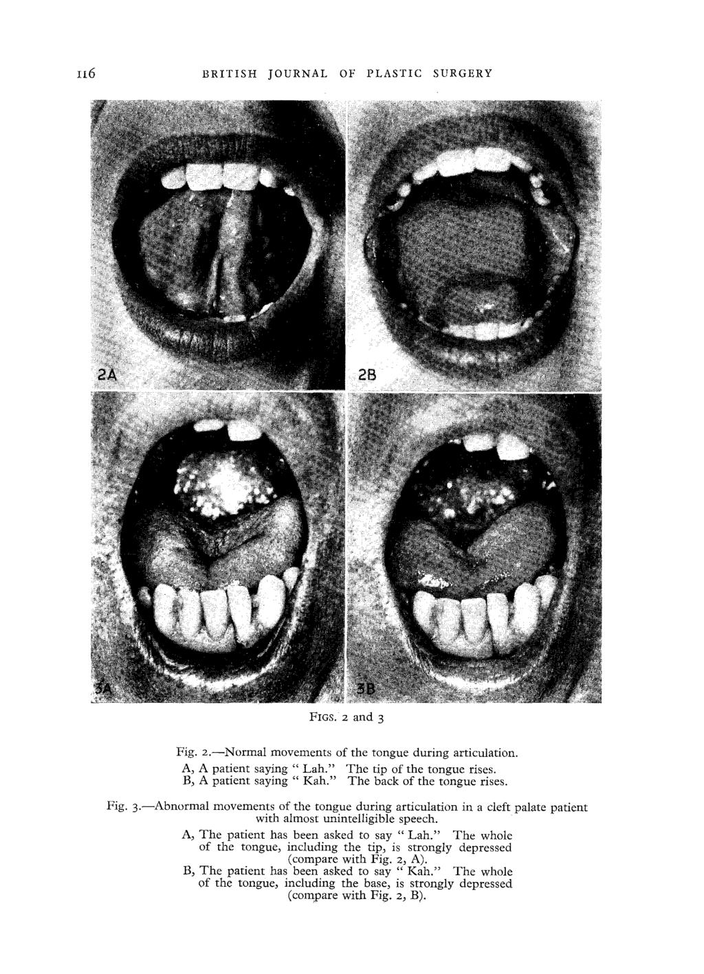 II6 BRITISH JOURNAL OF PLASTIC SURGERY FIGS, 2 and 3 Fig. 2.--Normal movements of the tongue during articulation. A, A patient saying " Lah.