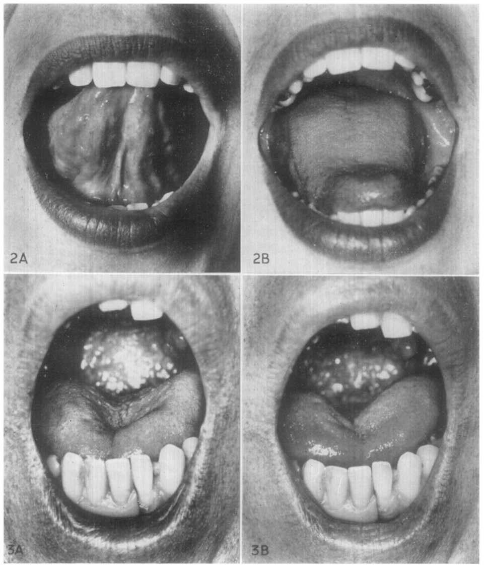--Abnormal movements of the tongue during articulation in a cleft palate patient with almost unintelligible speech.