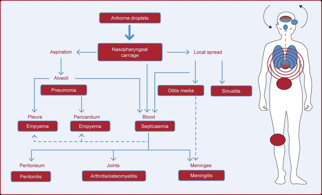 Possible progression pathway of disease Ref: Musher DM, in Mandell Principles and Practice of