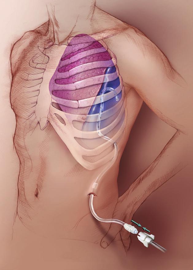 CHEST DRAINAGE Pleural Space Insertion