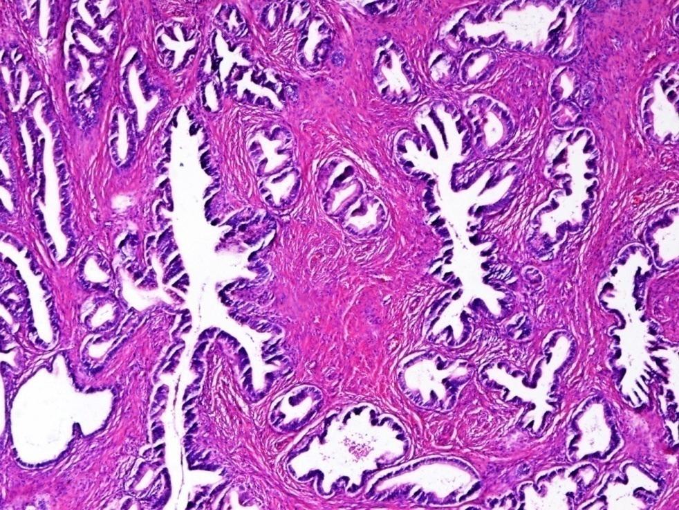 The second most common histopathological type of carcinoma was the endometroid type which accounted for 25% of all investigated cases. Other variants diagnosed include: serous adenocarcinoma (12.