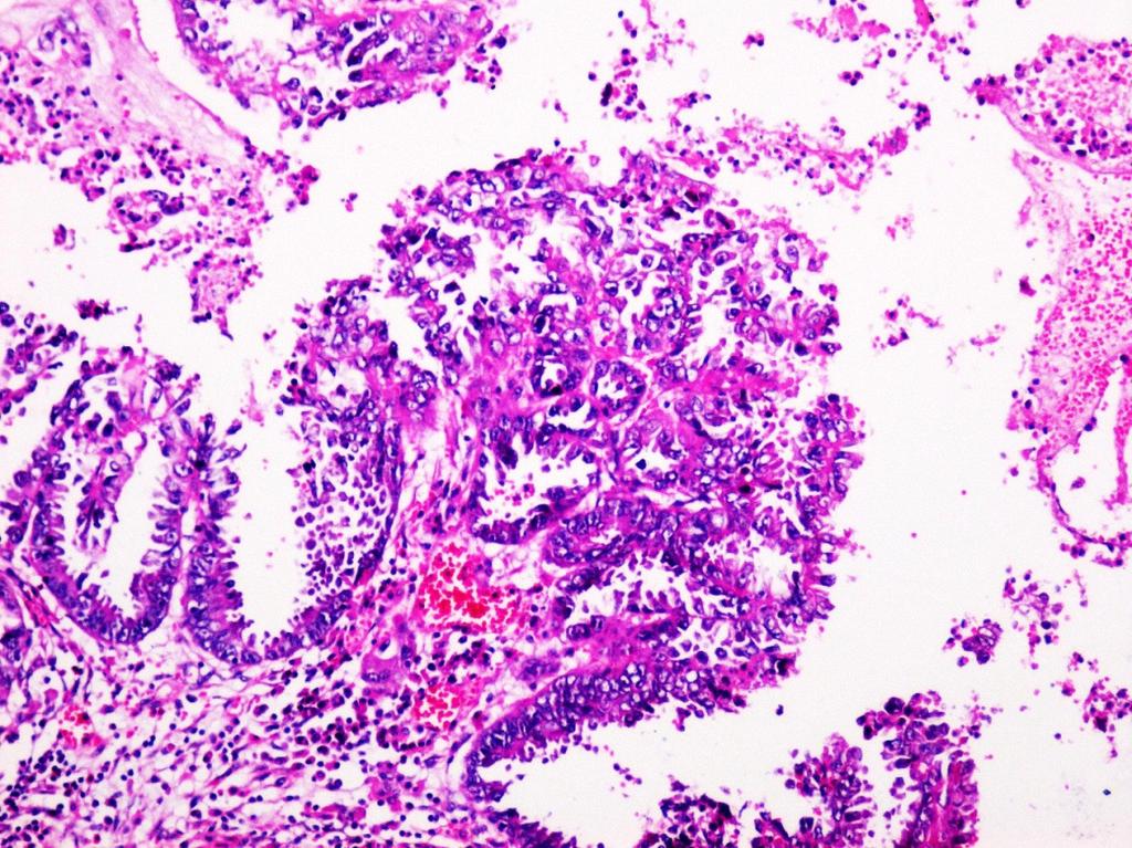 The most aggressive form of adenocarcinoma investigated proved to be the endometroid, the vast majority (75%) being diagnosed in advanced clinical stages IIIA and IIIB.