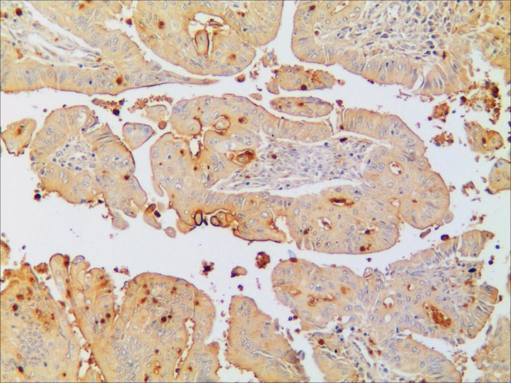 Fig. VI. Cervical adenocarcinomamucinous serous type. CEA positive reaction in the cytoplasm of neoplastic cells.dab, X100 Fig. VI.5 Cervical adenocarcinoma mucinous type.