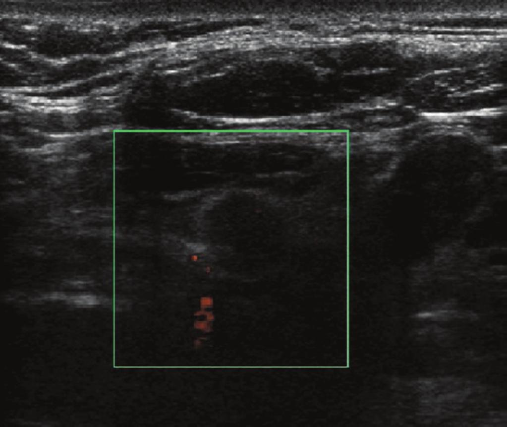 2 Figure 1: Thyroid ultrasound. Hypoechoic nodule in the inferior pole of the left thyroid lobe. Figure 2: Tissue sample. A 1.