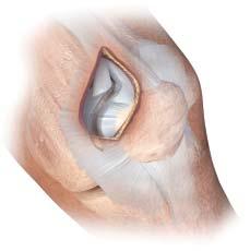 Incision and entry point: Lateral subluxation of the patella A midline skin incision is made from the