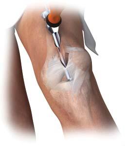 This incision is not midline, but through the medial one-third of the quadriceps tendon as outlined in the
