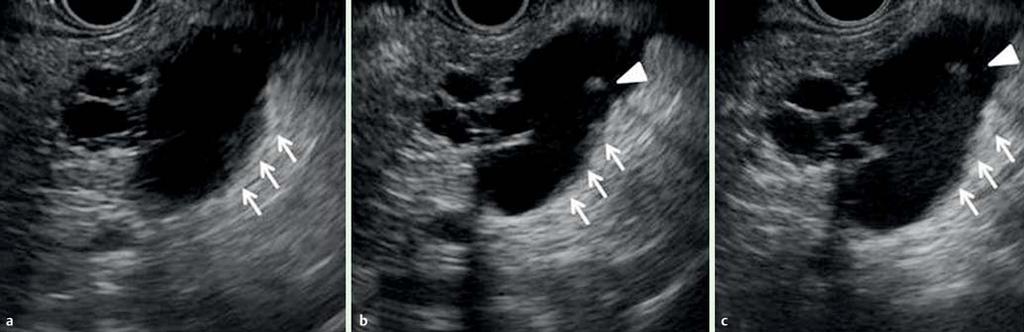 E6 Fig. Intraductal papillary mucinous neoplasm of the pancreatic body in a -year-old man.