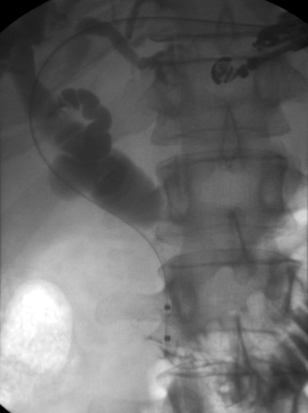 This can be accomplished by dilating over the guidewire with a 4 to 6 mm wire-guided balloon catheter or a 6 to 7 Fr dilating bougie followed by stent placement in an anterograde manner. 13 2.