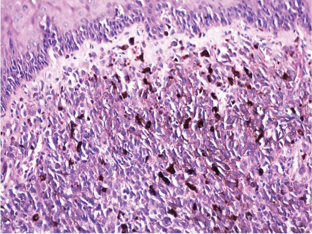 C Figure 7 Immunohistochemical staining positive for S100 (), HM45 (),