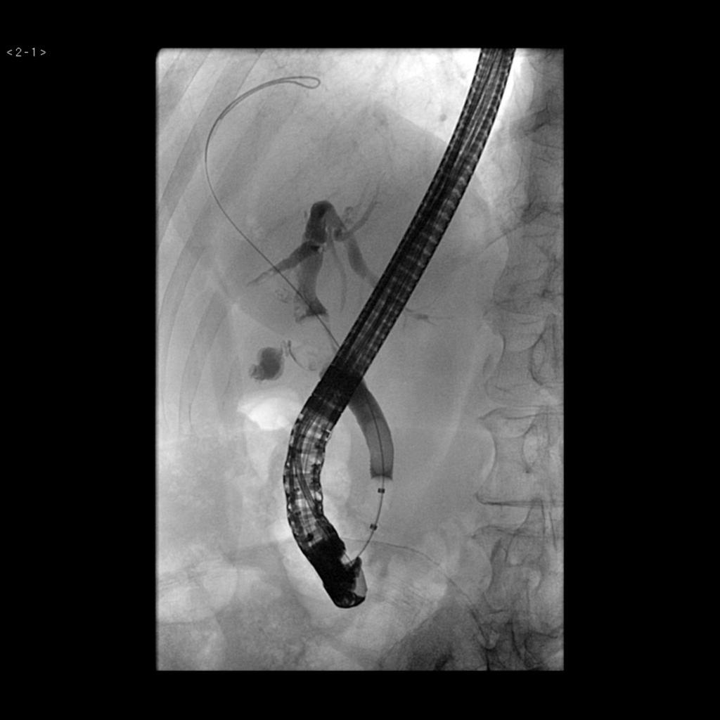 Fig. 6: ERCP confirmed a large impacted intraductal calculus at the