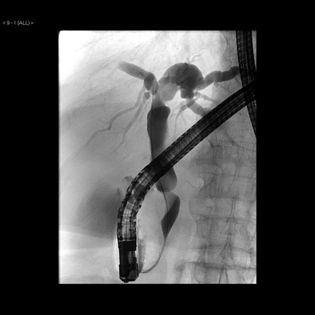 Fig. 10: ERCP confirmed biliary dilatation