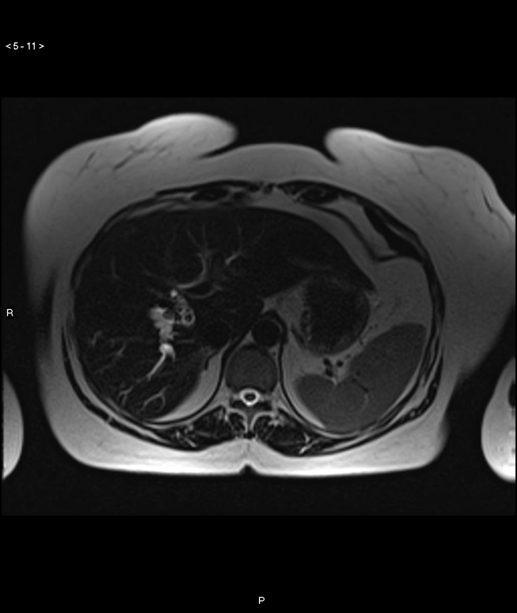 Fig. 13: A patient presented with right upper quadrant pain and cholestatic liver function tests.