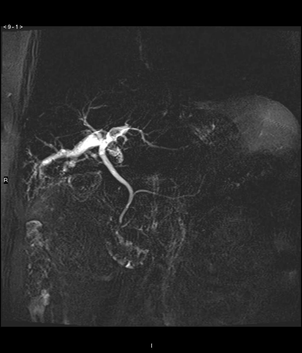 Fig. 14: MRCP demonstrating right hepatic duct stricture with