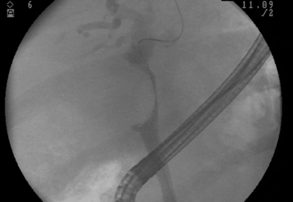 Fig. 20: ERCP nicely demonstrated a smooth extrinsic impression on the CHD.