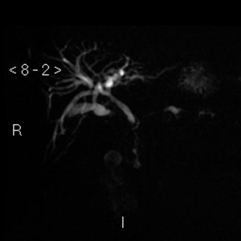 Fig. 22: MRCP confirmed CT findings of intra