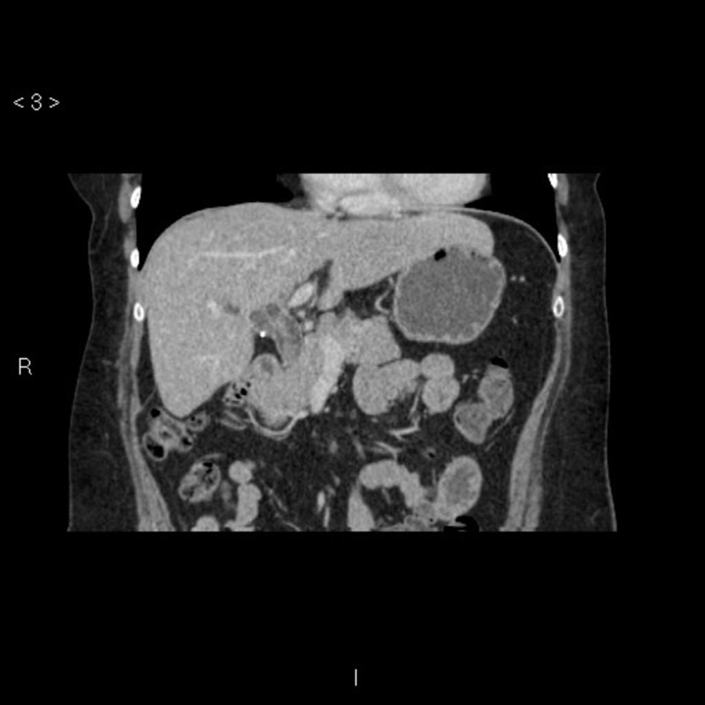 The sidebar shows cross-sectional images with corresponding endoscopic images depicting biliary strictures due to a varied etiology.