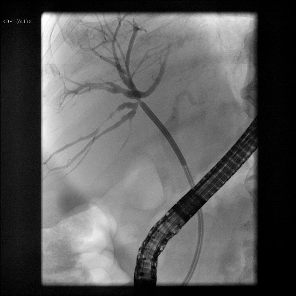 Fig. 4: Cholangiography at