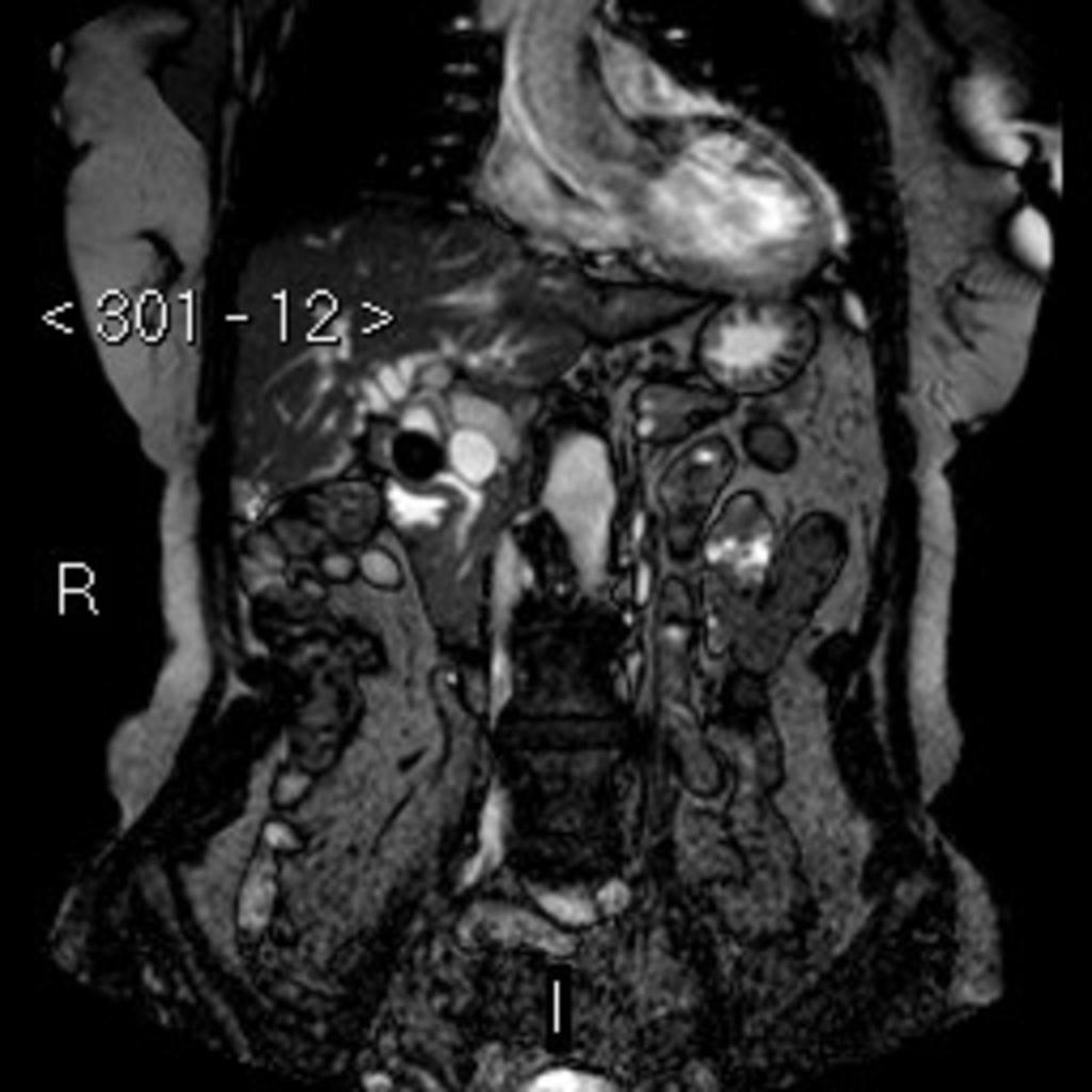 Fig. 5: MRI showing a large intraductal calculus in
