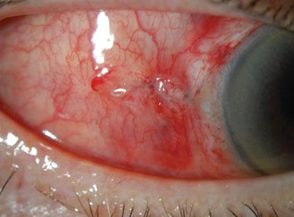 reduced corneal astigmatism, less inflammation and less disruption to the conjunctiva than with 20-gauge procedures 7 ALCON MIVS