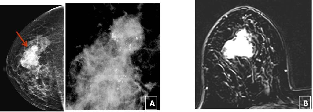 Fig. 7: Case 4. A 61-year-old woman with pathology proven IDC of right breast. A. MG(RCC) reveals about 5.1x3.