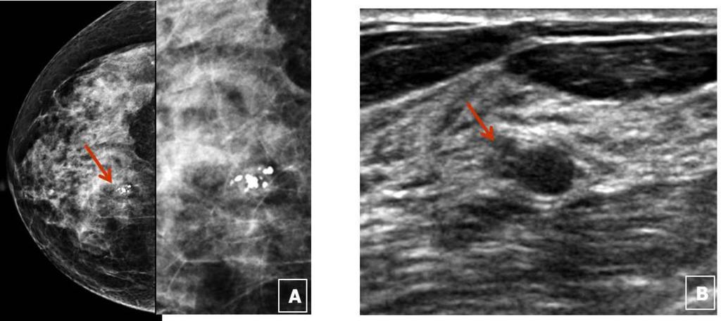 Fig. 5: Case 2. A 53-year-old woman with pathology proven FCC of right breast. A. RCC MG shows about 1cm sized relatively oval shaped isodense mass with clustered CHC in the right breast upper central portion.