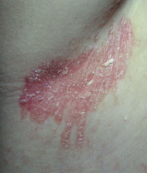 plaques are one of the typical features of psoriatic diaper rash with dissemination 2 (Figure 4).