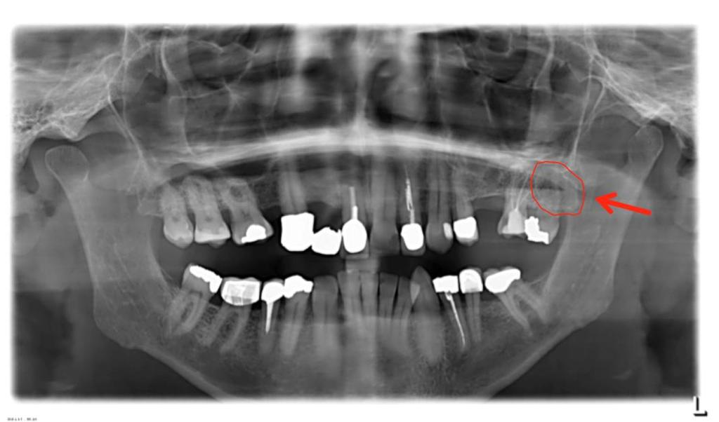 2. Case Report A 57-year-old patient with no systemic diseases presented with complaints about his much-elongated upper central incisor tooth (11), insufficient crowns and fillings as well as missing