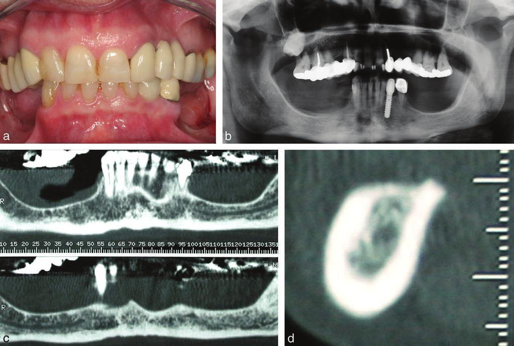 Vertical Ridge Augmentation: Case Report mm of bone height from the ridge to the mandibular canal) (Figures 1a through d). Prosthetic space was increased because of bone atrophy.