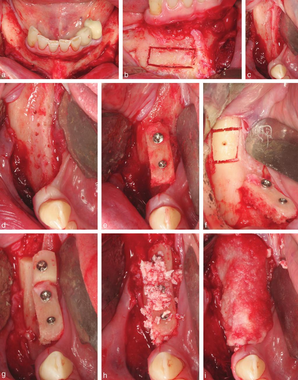 Peñarrocha et al FIGURE 2. Vertical augmentation surgery. (a) Flap raised, showing both mentonian nerves. (b) Chin graft with piezoelectric technique. (c) Alveolar ridge.