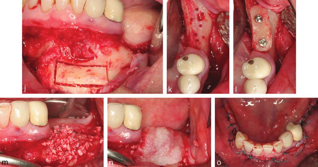 Vertical Ridge Augmentation: Case Report FIGURE 2. continued. FIGURE 3. Preoperative study, implant surgery, and implant loading.