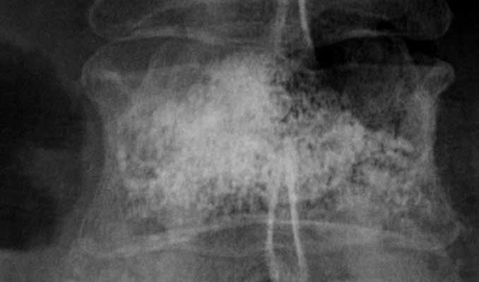 Cortoss Technique Guide Post-Operative Radiographs