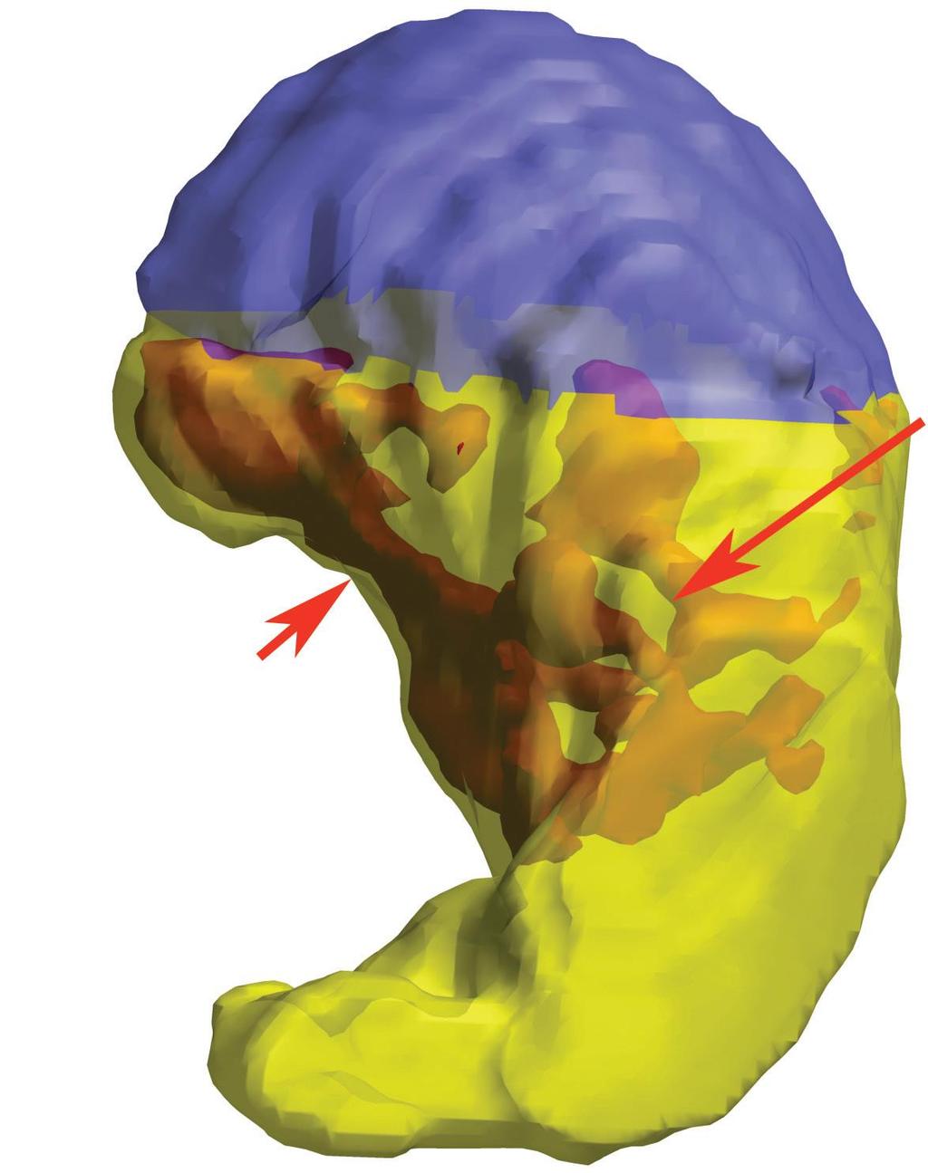 3D Reconstruction of MR Images Showing Gaviscon Raft Forming a Mechanical